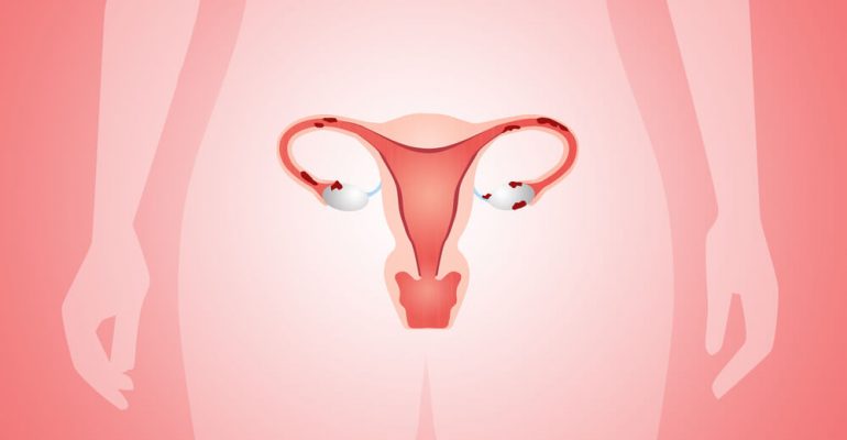 Hipolabor esclarece: o que é endometriose