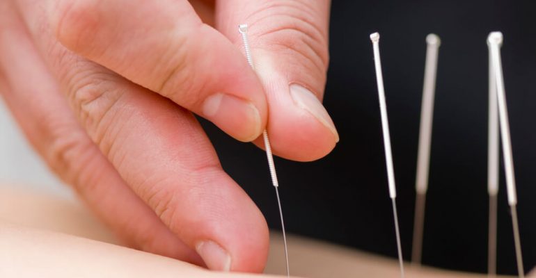 Hipolabor explica: os maiores benefícios da acupuntura