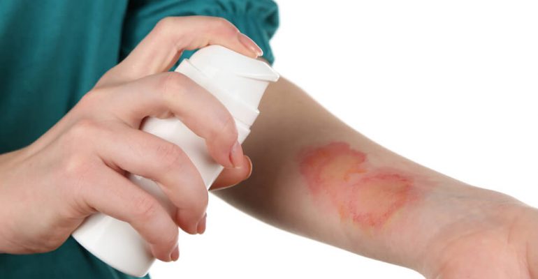 Hipolabor ajuda: Quais medicamentos usar para queimadura na pele?